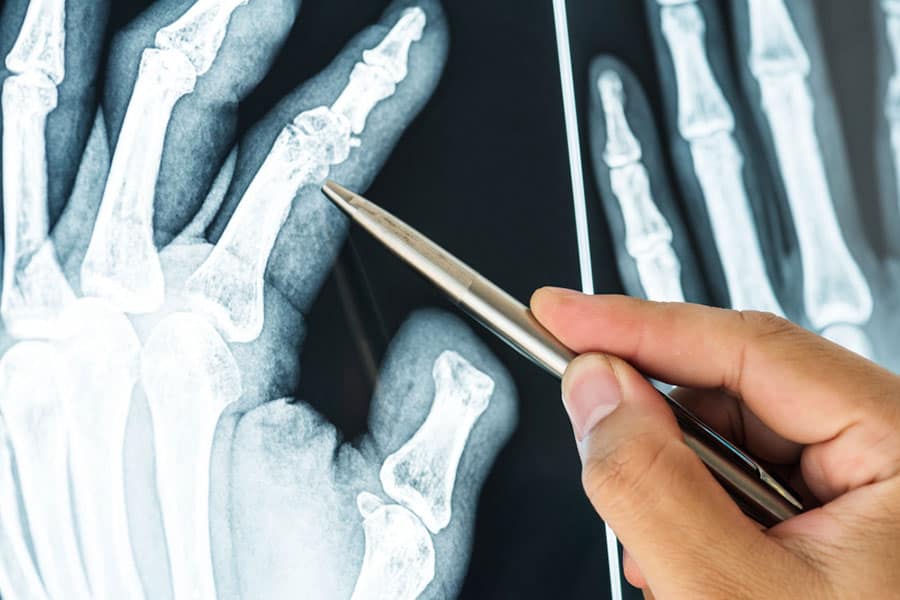 closeup-of-x-ray-film-of-fractured-finger-common-types-of-bone-fractures